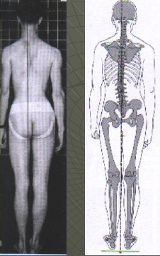 Basculación lateral de la pelvis