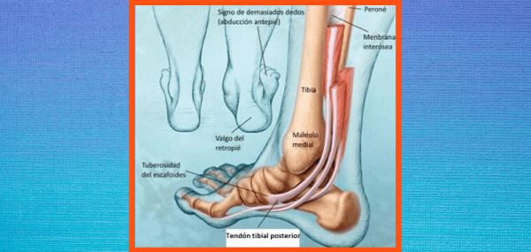 Las Lesiones Más Comunes Tendinitis Del Tibial Posterior 7787