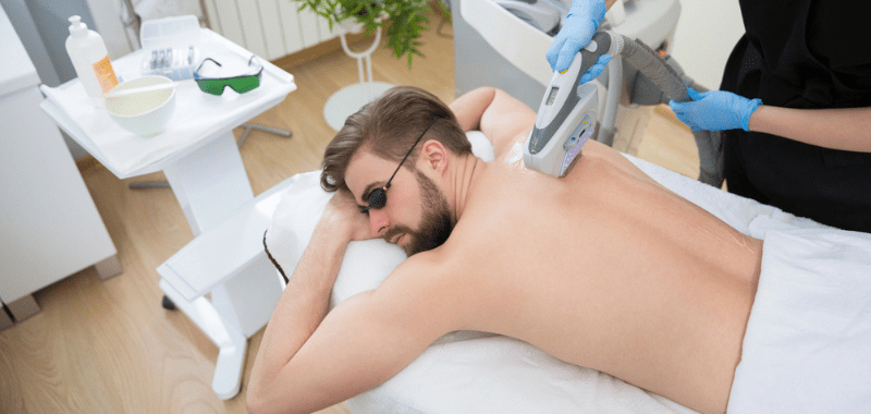 Depilación Laser masculina por soy maratonista